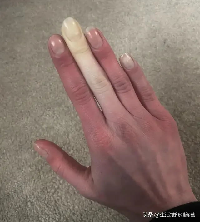 Raynaud’s syndrome