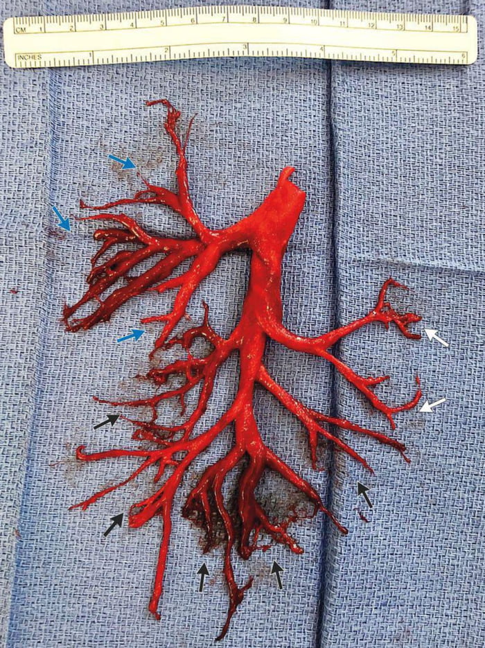 Blood clot coughed up by a patient that perfectly shaped the lungu2019s cavity it filled.